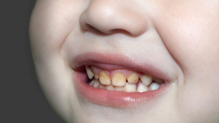 How To Remove Brown Stains From Baby Teeth